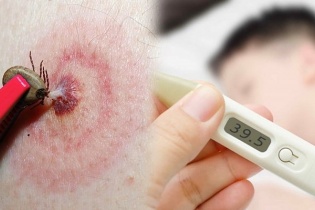 Tin mới y tế ngày 3/7: Điều trị cho bệnh nhân sốt mò biến chứng suy đa tạng