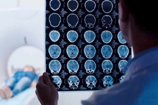 Tin mới y tế ngày 9/7: Các dấu hiệu cảnh báo mắc u não Schwannoma
