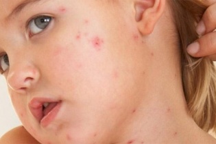 Cẩn trọng sởi trái mùa ở trẻ nhỏ