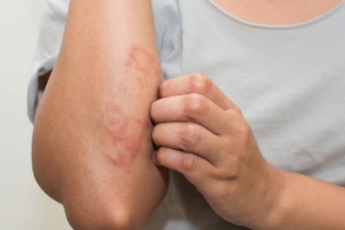 Tin mới y tế ngày 4/8: Cẩn trọng với các bệnh viêm da trong mùa mưa lũ