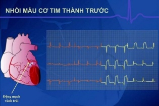 Ứng dụng công nghệ mới trong điều trị nhồi máu cơ tim