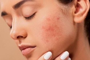 Bác sỹ chỉ ra sai lầm khi điều trị các bệnh về da