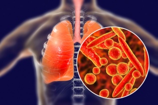 Dễ nhầm lẫn triệu trứng của bệnh lao với các bệnh tiêu hóa