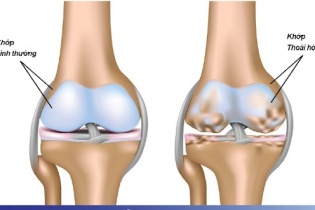 Gặp họa khi lạm dụng tiêm khớp gối nhằm giảm đau, trẻ hóa