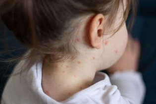 Dịch sởi vẫn đang tăng tại nhiều địa phương