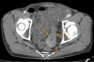 Khó phân biệt ung thư đại tràng với rối loạn tiêu hóa thông thường