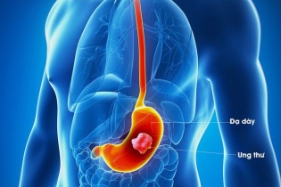 Tin mới y tế ngày 3/1: Dấu hiệu mắc ung thư dạ dày không được bỏ qua