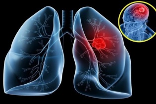 Tin mới y tế ngày 14/2: Hồi sinh người bệnh mắc ung thư phổi