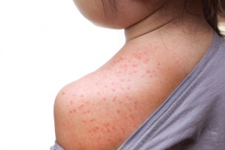 Sởi - bệnh truyền nhiễm nguy hiểm vào mùa Đông Xuân