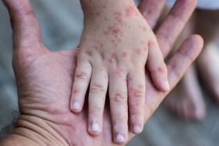 Mối lo lây nhiễm chéo sởi trong bệnh viện