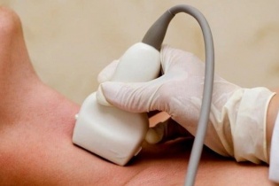 Cảnh giác với viêm tuyến giáp bán cấp từ những triệu chứng tưởng chừng đơn giản