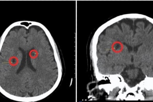 Can thiệp trong “giờ vàng” cứu bệnh nhân đột quỵ