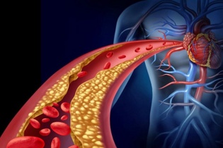 Rối loạn mỡ máu đang trẻ hóa