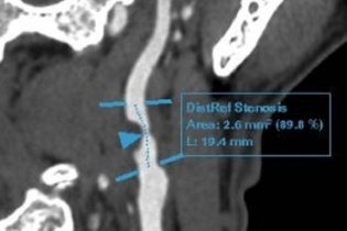 Hút thuốc lá 30 năm, phát hiện bệnh lý tim mạch nguy hiểm