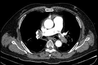 Mỗi điếu thuốc là một bước gần hơn tới phòng cấp cứu