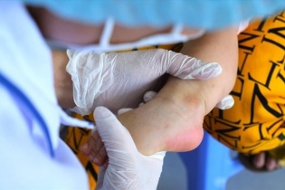 Dịch tay chân miệng gia tăng bất thường, nhiều trẻ biến chứng nặng