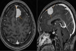 U màng não, bệnh lý tiến triển âm thầm nhưng nguy hiểm