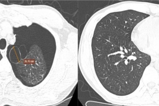 Kịp thời cứu sống người đàn ông bị tràn khí màng phổi nặng do vỡ kén khí