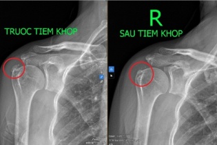 Đau vai âm ỉ kéo dài, dấu hiệu bệnh viêm gân vôi hóa