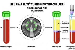 Chủ quan với chấn thương nhẹ, nguy cơ tổn thương gân kéo dài