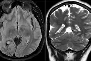 Triệu chứng quen thuộc hé lộ hội chứng mạch máu hiếm gặp