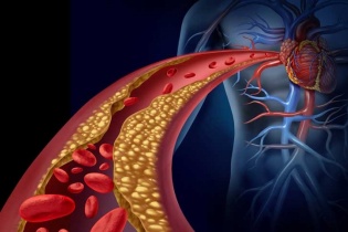 Tin mới y tế ngày 20/1: Bệnh nhồi máu cơ tim ngày càng bị trẻ hóa