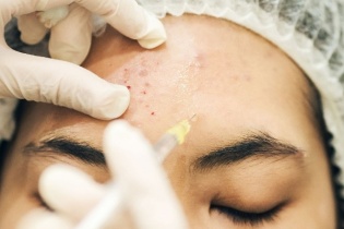 Làm đẹp “cấp tốc” đón Tết, tai biến không còn là chuyện hiếm