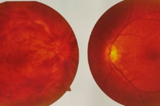 Cảnh báo nguy cơ mù lòa từ bệnh tắc tĩnh mạch trung tâm võng mạc