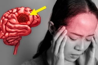 Đau đầu kéo dài, cô gái 31 tuổi phát hiện áp xe não