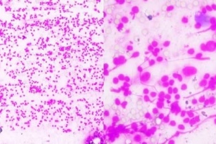 Hạch vùng cổ bất thường, cảnh báo nguy cơ ung thư hạch Hodgkin