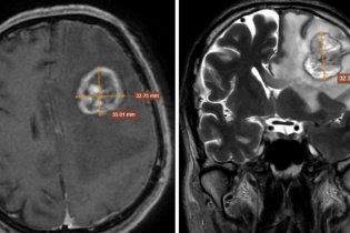 Từ khối bất thường vùng ngực phát hiện ung thư di căn hiếm gặp