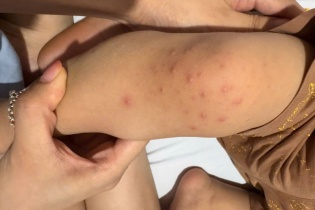 Nhiều trẻ mắc tay chân miệng không rõ triệu chứng, tăng nguy cơ biến chứng nặng