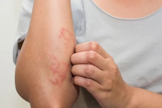 Tin mới y tế ngày 17/4: Cảnh báo biến chứng của zona thần kinh