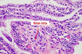Phát hiện ung thư tuyến giáp sau lần khám định kỳ