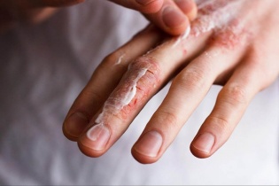 Tin mới y tế ngày 5/7: Nhiều trẻ nhập viện vì bệnh vảy cá bẩm sinh