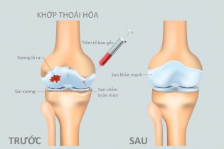 Tăng nặng cơn đau thoái hoá khớp do thừa cân, béo phì