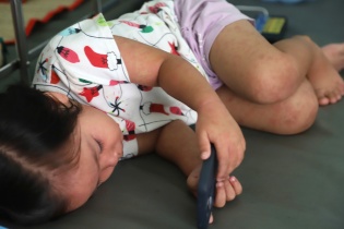 TP.HCM quyết định công bố dịch sởi trên toàn địa bàn 