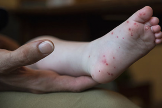 TP.HCM chỉ đạo khẩn khi ca bệnh tay chân miệng tiếp tục gia tăng