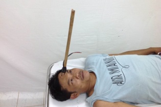 “Cẩu tặc” bắn mũi chĩa dài 40 cm găm vào trán tuần tra nhân dân
