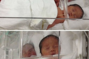 Ca sinh tư hy hữu ở Hà Nội